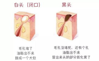 辨別黑頭與閉口，黑頭儀的正確使用與誤區